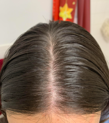 Hairloss Treatment