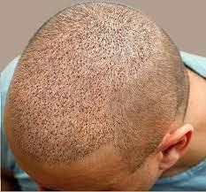 Hair Transplantation