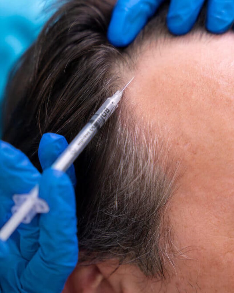 PRP-Hair-Treatment-In-Roorkee